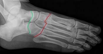 radiografia do pé com ligamentos de chopart e lisfranc